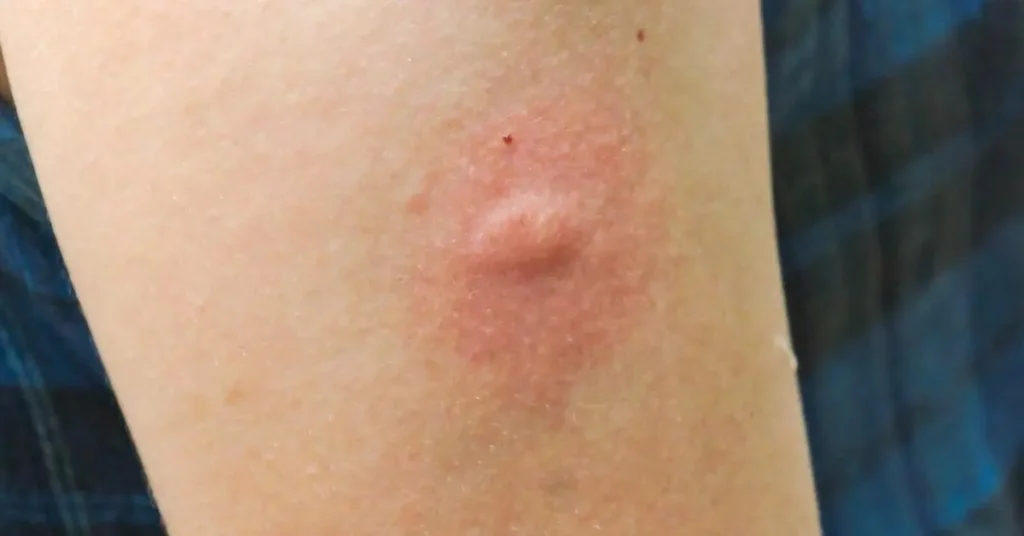 Picadura mosquito tigre